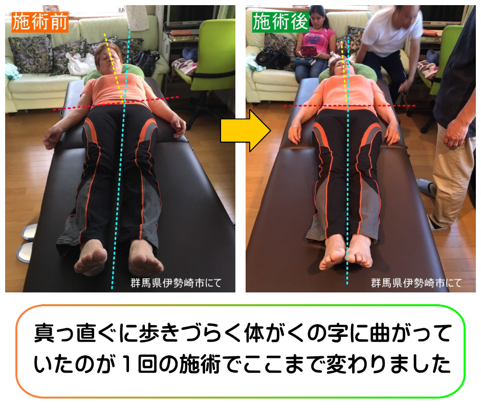 くの字に曲がった体のせいで歩きづらかったのが1回の施術で解消しました